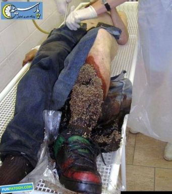 Man With Maggots In Leg