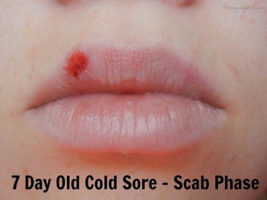 Abreva Cold Sore Stages